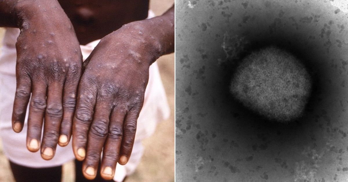 La OMS teme que la viruela del mono se instale en países en donde no existía una transmisión endémica