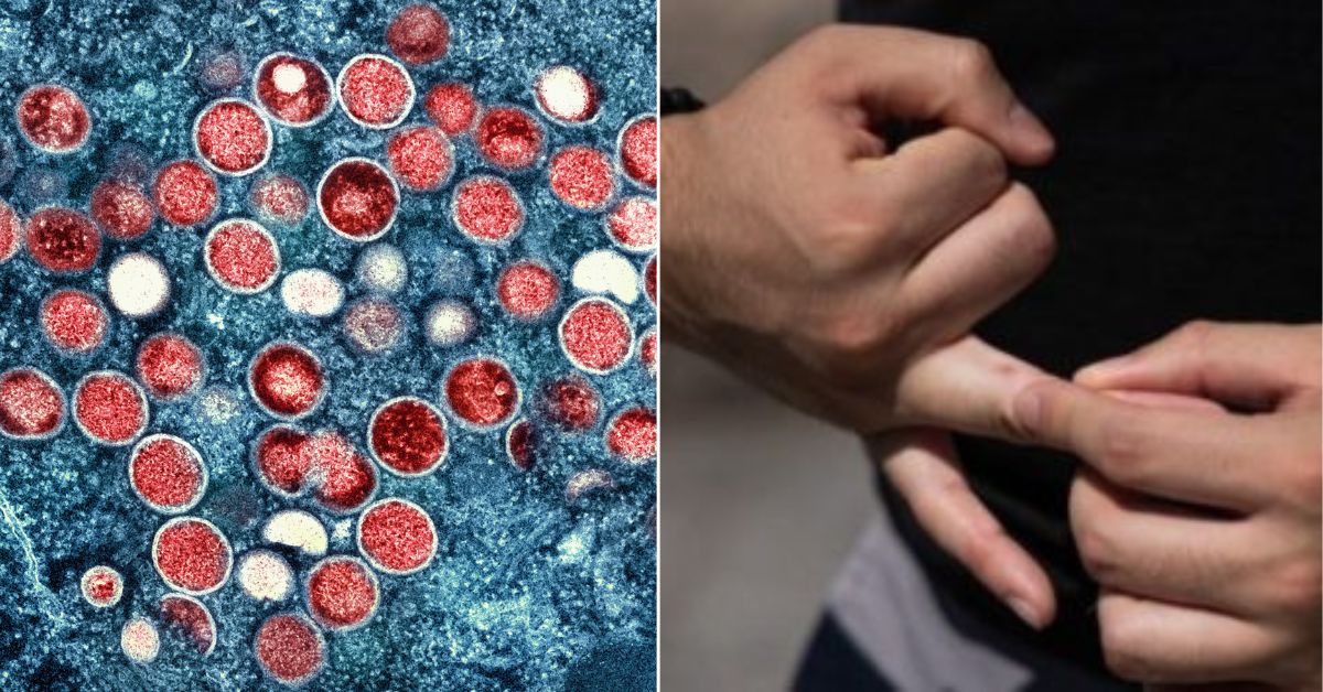 ‘Mpox’: la OMS decidió cambiarle el nombre a la viruela del mono para evitar estigmatizaciones